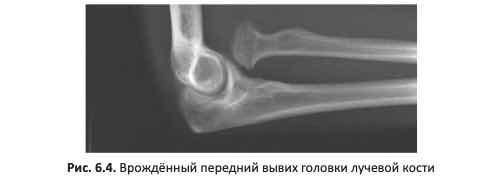 Врождённый передний вывих головки лучевой кости