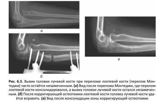 Вывих головки лучевой кости при переломе локтевой кости (перелом Мон- теджи) часто остаётся незамеченным