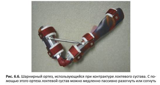 Шарнирный ортез, использующийся при контрактуре локтевого суставай