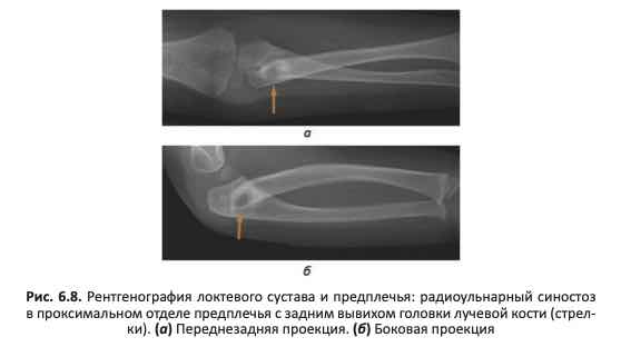 Рентгенография локтевого сустава и предплечья: радиоульнарный синостоз в проксимальном отделе предплечья с задним вывихом головки лучевой кости