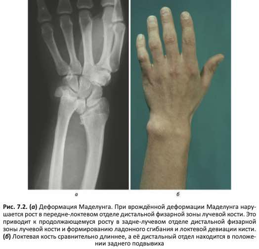 Деформация Маделунга