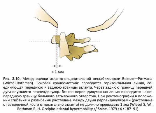 атланто-окципитальную нестабильность