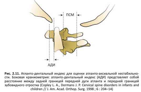 Атланто-дентальный индекс