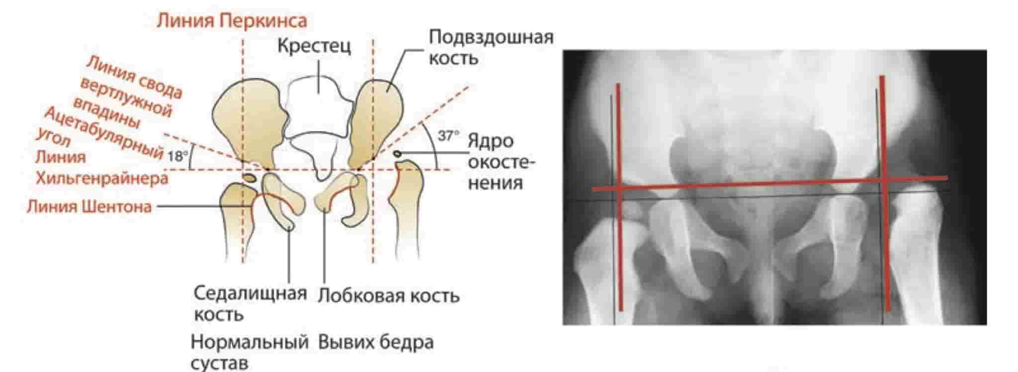 Рентгенограмма таза в переднезадней проекции (схема) при дисплазии