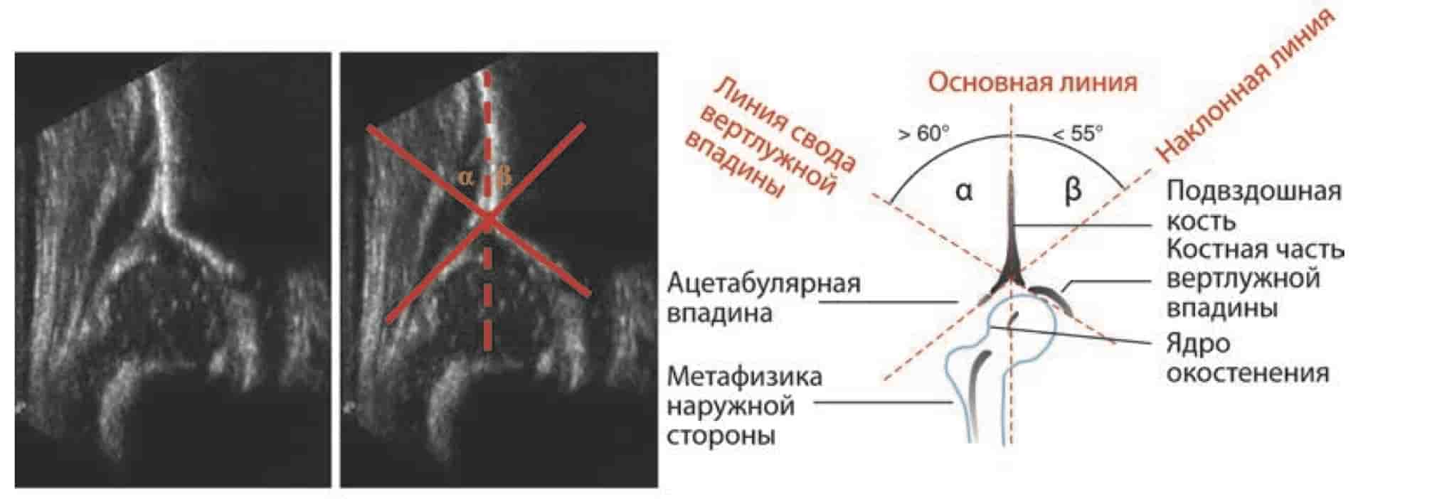 Схема УЗИ при дисплазии