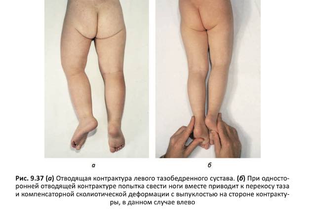 Контрактура тазобедренного сустава у ребенка