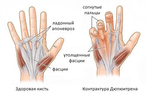 Контрактура Дюпюитрена