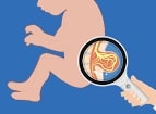 Лечение Spina bifida в России | рекомендации НМИЦ им. Г. И. Турнера