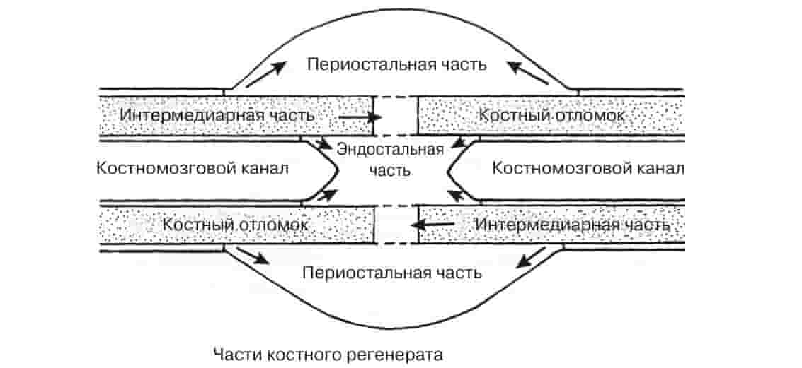 образование костной мозоли 