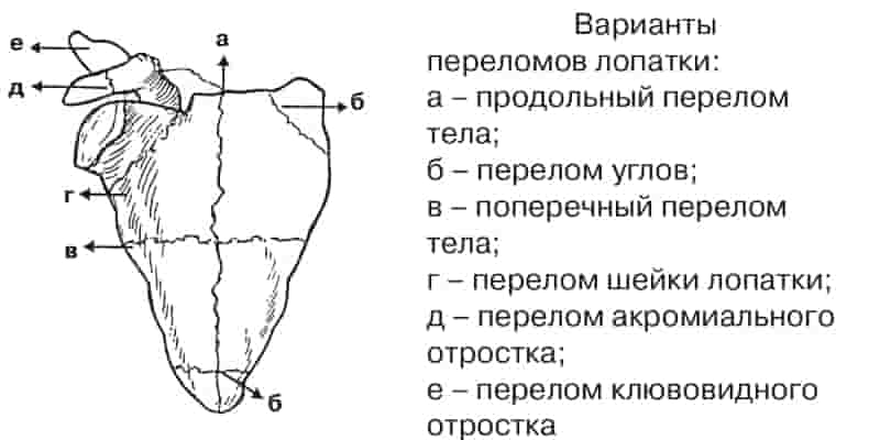 переломы лопатки