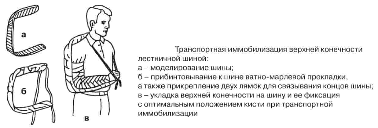транспортная иммобилизация