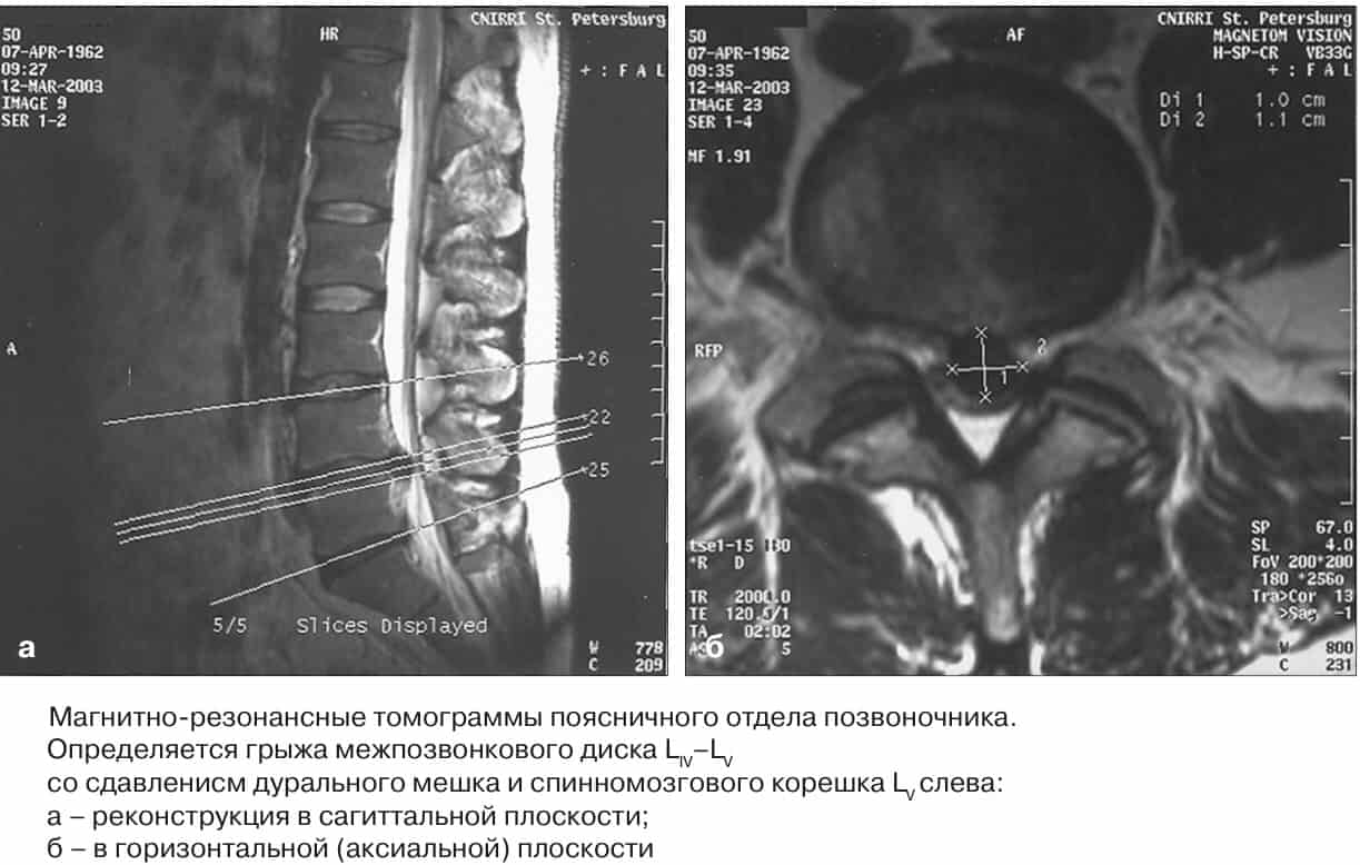 МРТ при остеохондрозе позвоночника