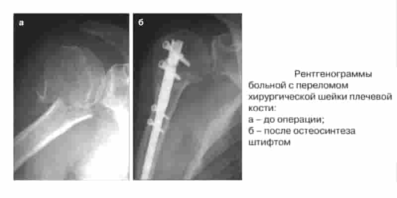 Перелом хирургической шейки плечевой кости фиксированный штифтом