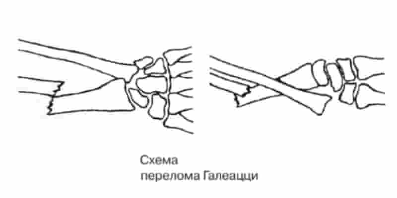 перелом Галеацци