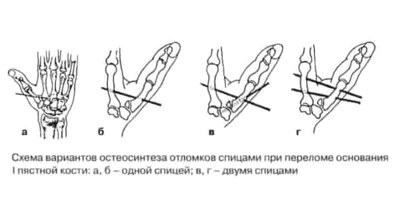 Варианты операций при переломе 1й пястной кости