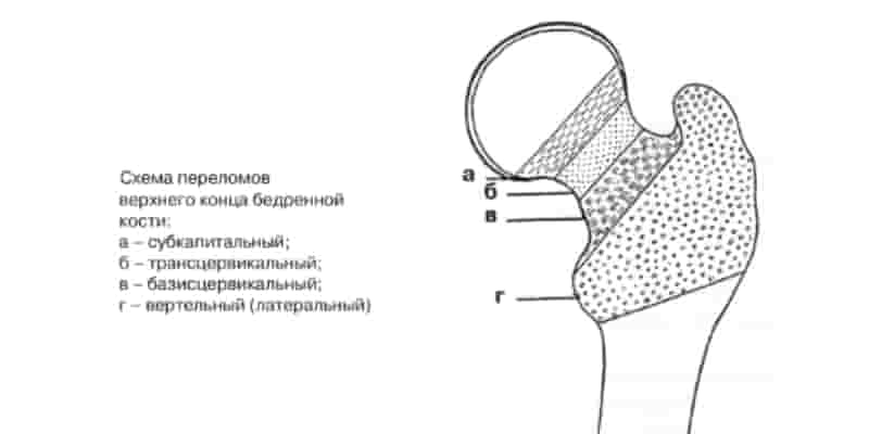 Схема переломов шейки бедра