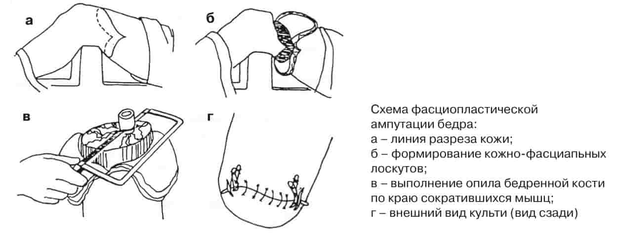 Схема фасциопластической ампутации